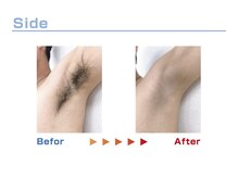 キングスサロン 熊本/脇脱毛