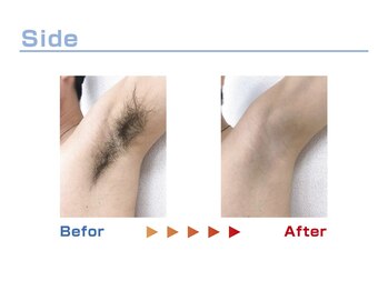 キングスサロン 熊本/脇脱毛