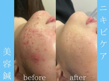 ビープラス(BEE PLUS)/ニキビケア