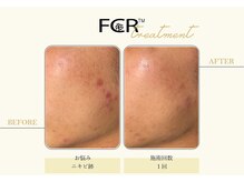 ハーバル 新宿店(HERBAL)/最強★韓国FCRハーブピーリング