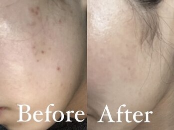 ハリナチュレ 西心斎橋店(HARINATURE)/Before After