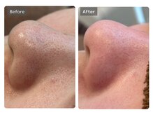 エミルカ 宮崎店(EMILUCA)/【クーポン有】角栓を奥底から！