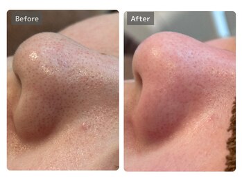 エミルカ 宮崎店(EMILUCA)/【クーポン有】角栓を奥底から！