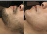 青髭や角質にお悩みの方★WAX脱毛3パーツ(おでこ、鼻、鼻下)￥4000
