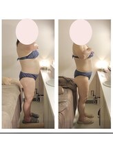 アクア エステティコ 亀有(ACQUA estetico)/脂肪燃焼 腹部 50代　4ヶ月経過