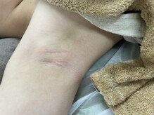 ナノハナ/鹿沼市全身脱毛美容室ナノハナ