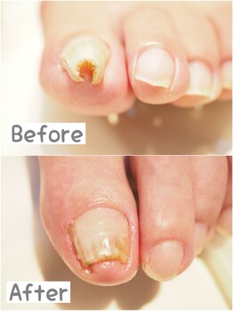 巻き爪補正（B/S）