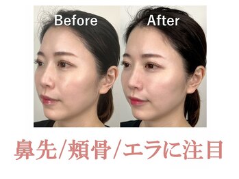 ラプリエイル 千葉店(Raplit aile)/ 隆鼻+輪郭矯正40分