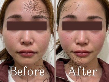 ワン(One)/美容鍼でスッキリ小顔へ