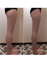 クリニカルエステ イーズ 三宮店/【レモンボトル】下半身太り解消