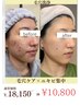 【毛穴ケア×ニキビ集中エステ】毛穴洗浄¥18,150→¥10,800