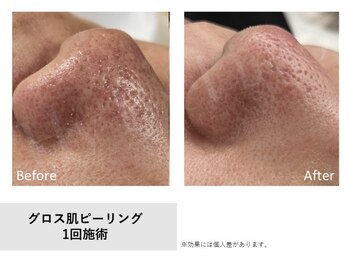 サロン ド ユイ(salon de yui)の写真/【上通×個室】40代からのたるみ毛穴改善！ハイピール×導入で透明感あふれるノーファンデ美肌へ♪
