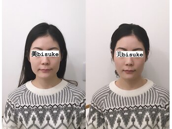 美助(bisuke)/小顔施術１回のお写真