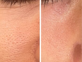 ジーニー(Genie)/ララピール