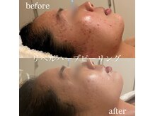 クリアビューティー(CLEAR BEAUTY)の雰囲気(ハーブピーリング/ニキビケア)