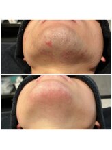 エニー(Any)/脱毛で美肌☆