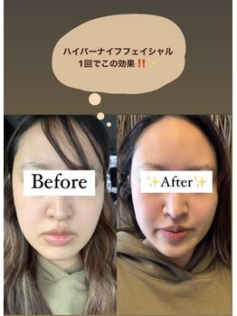 アローナ(ARONA)/ハイパーナイフEXフェイシャル