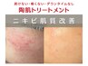 【ニキビケアNO.1】赤みを落ち着かせ、できにくいお肌へと改善