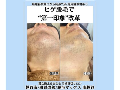 脱毛マックス 南越谷店(MAX)の写真