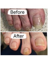 フットファースト 名古屋池下店/自分では難しい爪カットもお任せ