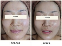 REVI陶肌トリートメントとプラズマ施術であらゆるる悩みに対応！