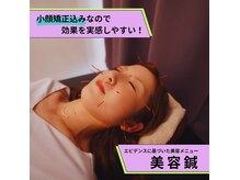 美容鍼でスッキリ小顔に♪