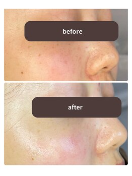 シフォン(Chiffon)/ハーブピーリングと毛穴洗浄