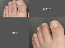 テリー(Terry)/men's脱毛before after 5回照射