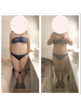 アクア エステティコ 亀有(ACQUA estetico)/脂肪燃焼 腹部 50代　4ヶ月経過
