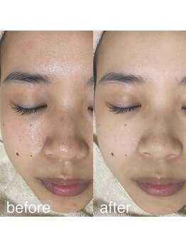 アルム(a'lm)/毛穴詰まり、くすみにも！小顔へ