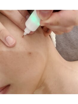 アグライア(Aglaea)/シミケア施術/経過