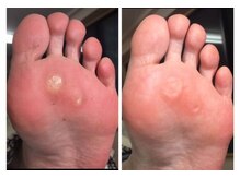 厚木 海老名 巻き爪矯正センター/事例【ドイツ式フットケア】