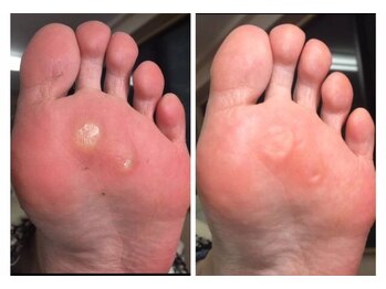 事例【ドイツ式フットケア】