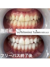 ホワイトニングサロン 京都烏丸店/ホワイトニング施術例　