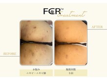 ハーバル 新宿店(HERBAL)/最強★韓国FCRハーブピーリング