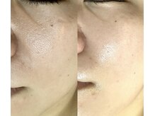 サロン ド グレイシャス エステティック(Salon de GRACIOUS esthetic)/光フェイシャル