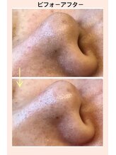 リファイン(REFINE)/毛穴ごっそり！気になる小鼻汚れ