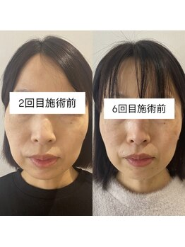 リアプア(Li'a)/4回でも変化 小顔/リフトアップ