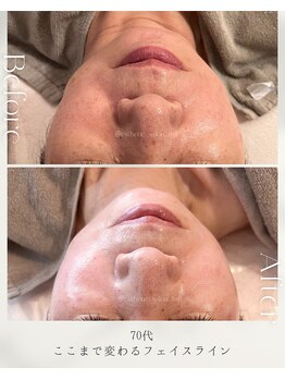 フル(Full)/【70代のフェイスライン変化】