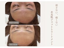 ヴィヴィアン 熊谷店(Vivian)/【刺さない】ACトリートメント