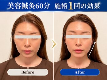 トウヨウビジン 美容鍼灸サロン(TOYO BIJIN)の写真/OPEN記念クーポン5,900円 速攻小顔スッキリラインが叶う◎カウンセリング込み・美容鍼＋小顔矯正組み合わせ