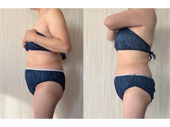 キアラ(Chiara)/痩身マシーン☆上半身コース