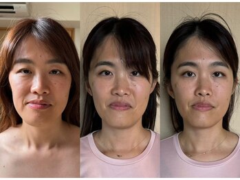 環/小顔矯正ビフォーアフター