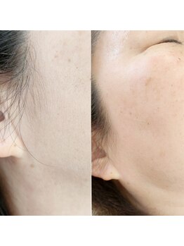 ハナナ(hanana)の写真/《フェイシャルwax》産毛がなくなりお肌のトーンが明るくなる☆日々のスキンケアの浸透率UPにも◎