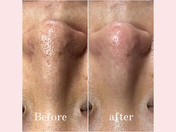 ティーツリー 名古屋 桜山(Tea Tree)/【毛穴ケア・毛穴洗浄】