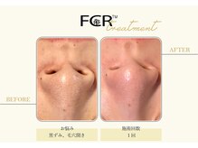 ハーバル 新宿店(HERBAL)/最強★韓国FCRハーブピーリング