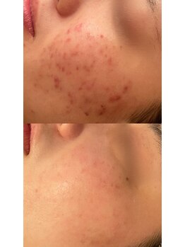 ビジュープラス(Bijou+)/剥離無しハーブピーリング