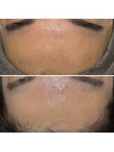 ロッタ エクリュ(Lotta ecru+)/REVI剥けないハーブピーリング