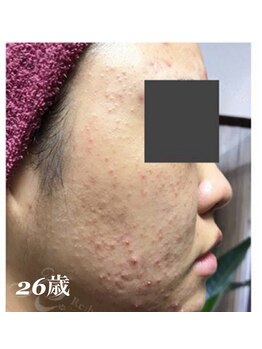 リベル 名古屋(Lebelle:)/ハーブピーリング 名古屋