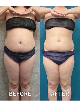 ブランシュムーニー(BRANCHE MOONY)/お腹脂肪冷却